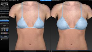 Simulation breast sculptor for augmentation by VECTRA® XT 3D Imaging System