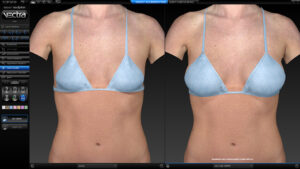 Simulation breast sculptor for augmentation by VECTRA® XT 3D Imaging System