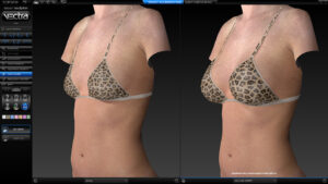 Simulation breast sculptor for augmentation (oblique angle view) by VECTRA® XT 3D Imaging System