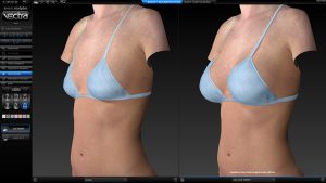 Simulation breast sculptor for augmentation (oblique angle view) by VECTRA® XT 3D Imaging System