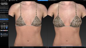 Simulation breast sculptor for augmentation by VECTRA® XT 3D Imaging System