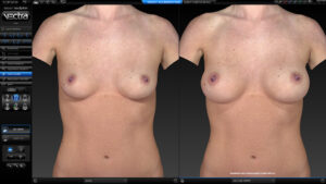 Simulation breast sculptor for augmentation by VECTRA® XT 3D Imaging System