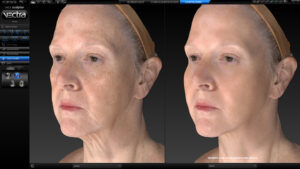 Simulation for facial contouring by VECTRA® XT 3D Imaging System