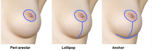Diagram of periareolar (around the areola), lollipop (around the areola and down to the crease beneath the breast), and anchor (around the areola, down the breast, and horizontally along the breast crease) incisions