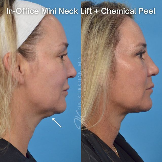 Neck Lift Fort Worth Dallas TX